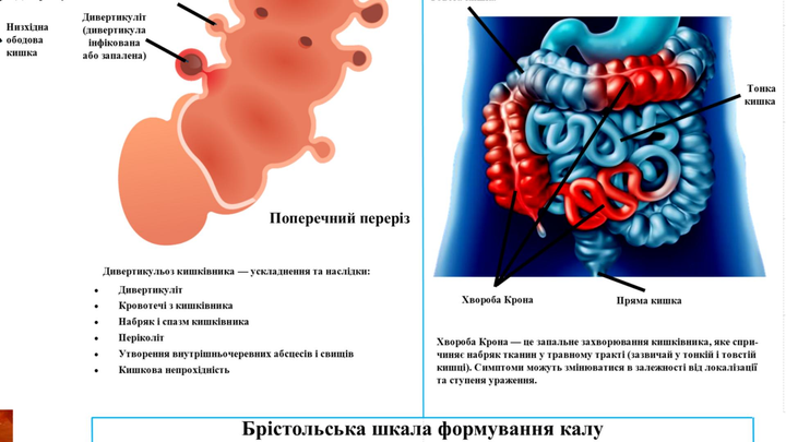 Анатомический плакат Болезни кишечника P0068 фото